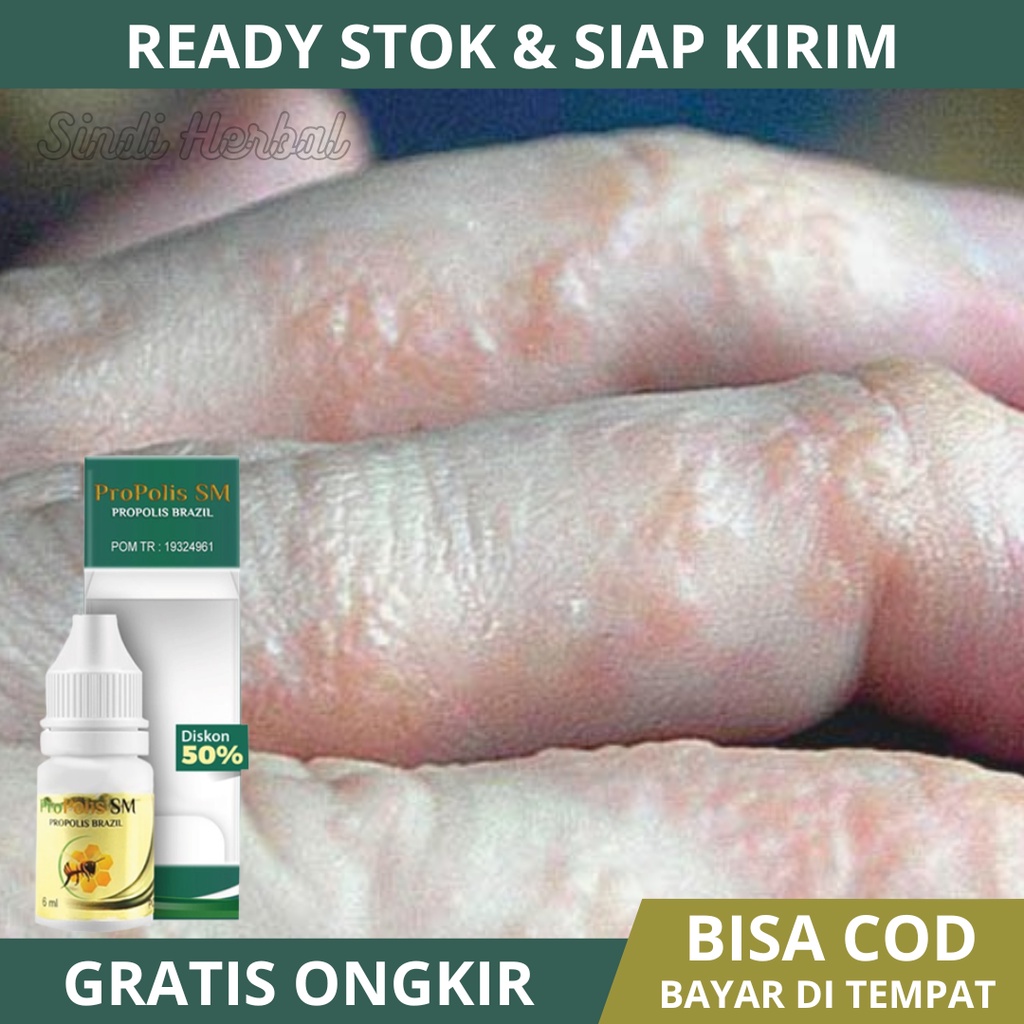 Obat Gatal Berair Di Jari Tangan, Obat Gatal Berair Dan Menyebar, Obat Gatal Berair Di Telapak Tanga