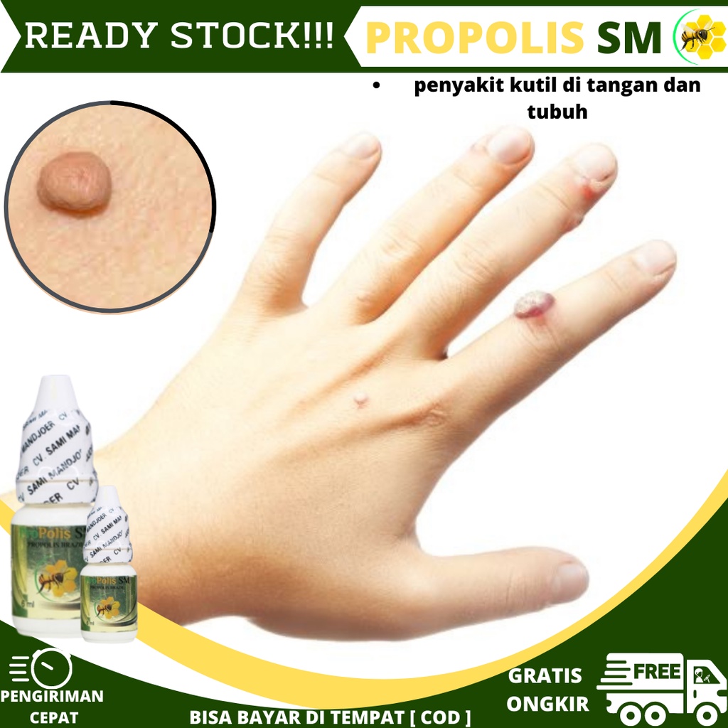 Obat Kutil Papiloma, Skin Tag, Obat Oles Penghilang Kutil Di Tangan, Penghilang Kutil Di Jari Tangan