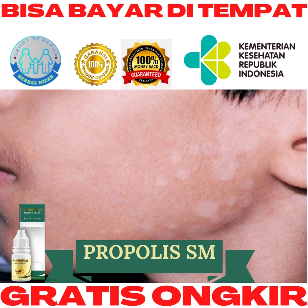 Obat Panu - Obat Panu di Wajah, Obat Panu di Leher dan Punggung, Obat Penghilang Hapur di Sekujur Tu