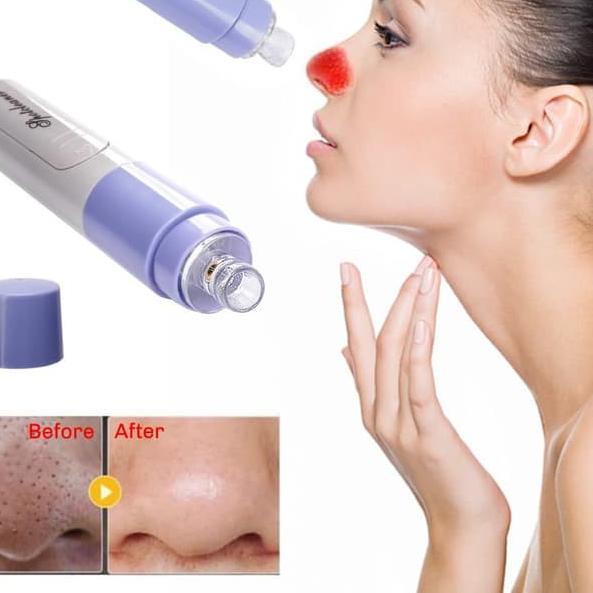 Alat Penyedot Komedo Cleaner Acne Vacuum Komedo