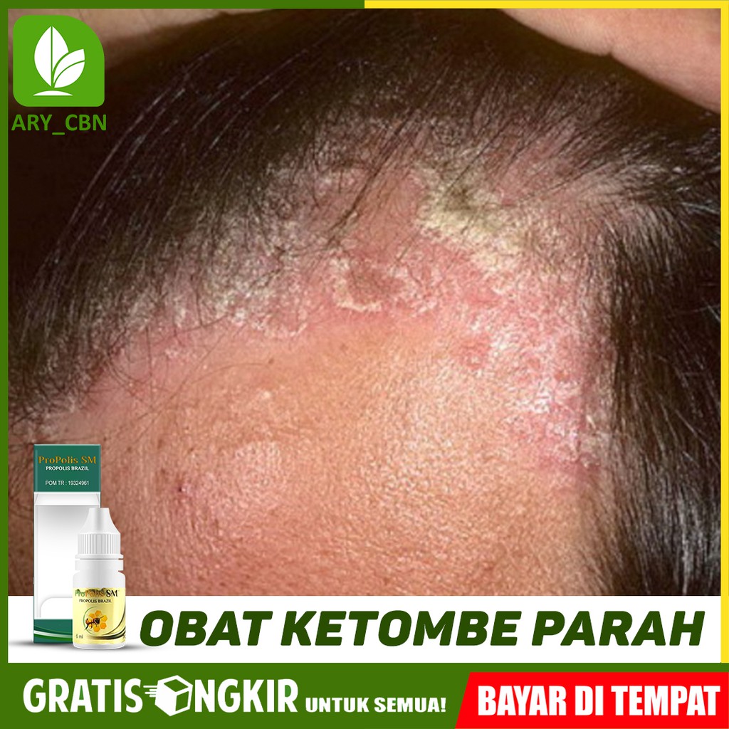 

Obat Ketombe Parah, Berkerak Dan Kering Psoriasis Di Kepala Herbal PROPOLIS SM Di Cirebon Bisa COD