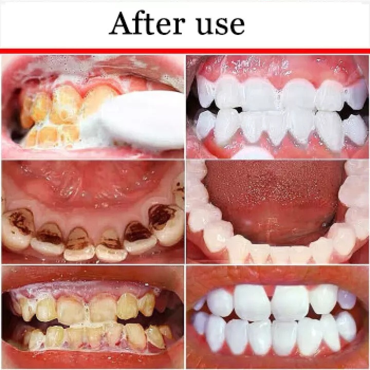 odol pemutih gigi dan karang gigi pemutih gigi permanen teeth whitening pemutih gigi dan penghilang karang gigi pasta gigi pemutih Perawatan Pemutihan Gigi/Menghilangkan Gigi Kuning/Menghilangkan Noda Tembakau / Noda Teh