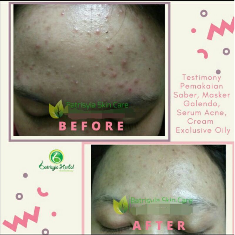 Cream Pemutih wajah jerawat berminyak BPOM Exclusive Oily batrisyia hebal