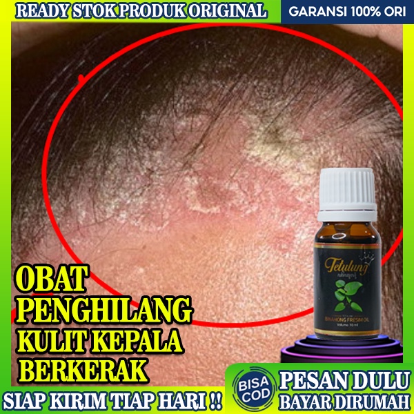 Obat Kulit Kepala Borok Bernanah Dan Berdarah Paling Ampuh - Obat Kulit Kepala Borok, Bisul, Benjola