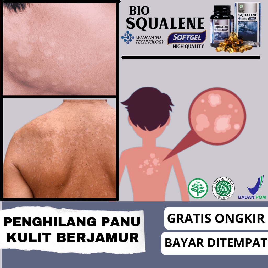Obat Tetes Panu - Obat Panu Cair - Obat Panu Wajah - Bercak Putih di Wajah - Menghilangkan Panu - Ku