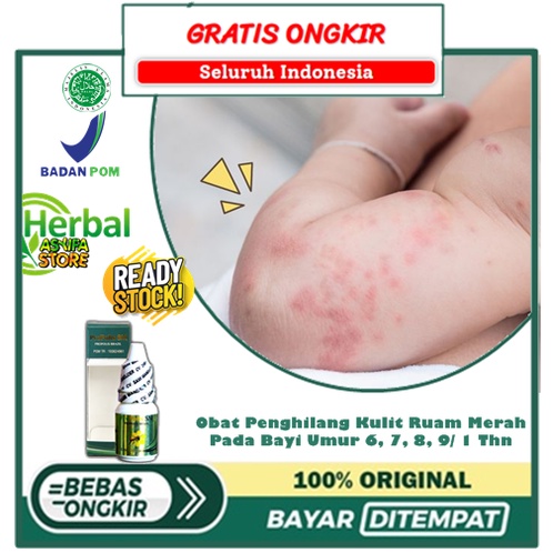 Obat Penghilang Kulit Ruam Merah di punggung, Tangan, Kaki Pada Bayi Umur 6, 7, 8, 9/ 1 Thn - Salep 