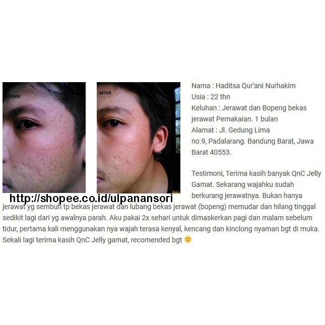 Khasiat Dan Manfaat Qnc Jelly Gamat Untuk Kecantikan Masker Teripang Emas Alami Indonesia