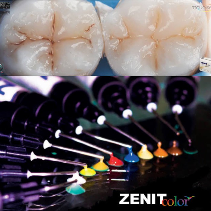 Alice dental // Zenit color composite flow / komposit warna stain / bahan tambal gigi rainbow