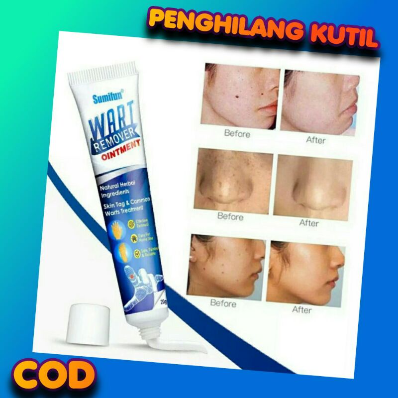 AD Skin tag Remover Krim Penghilang Kutil