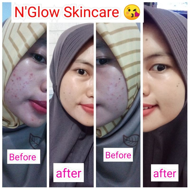 NGLOW SKINCARE NORMAL DAN ACNE ORIGINAL BPOM-5