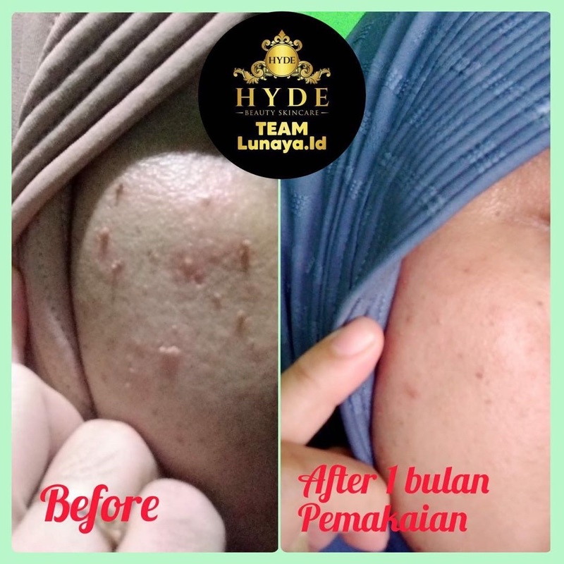 HYDE BEAUTY SKINCARE PAKET GLOWING PEMUTIH WAJAH PENGHILANG FLEK JERAWAT ORIGINAL BPOM HYDE SKINCARE ORIGINAL