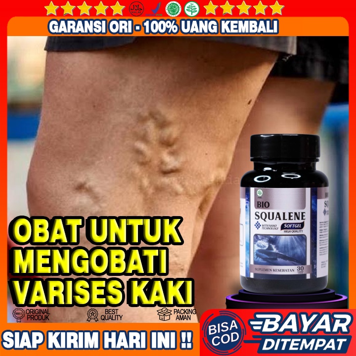 Obat Verises - Obat Varises Di Kaki - Obat Varises Di Betis Kaki - Obat Varises - Obat Urat Murungku