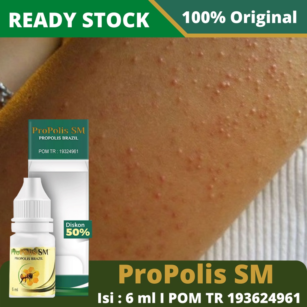 Obat Keratosis Pilaris, Penyakit Kulit Ayam, Penghilang Bintik Pada Kulit, Obat Oles Keratosis Pilaris, Salep Gatal Keratosis Pilaris, Menghilangkan Keratosis Pilaris di Tangan, Bruntusan, Pori Pori Melebar, Benjolan Keratosis Pilaris Anak dgn Propolis SM