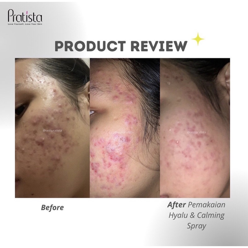 【Official Outlet】 PRATISTA - Facemist Calming Spray Cica Hydrating Mist Hyalu Toner Serum Retinol Renewal Pelembab Anti Acne Aging Penghilang Noda Bekas Jerawat Flek Hitam Pencegah Penuaan Dini Garis Halus Mencerahkan Melembabkan Skincare Viral BPOM