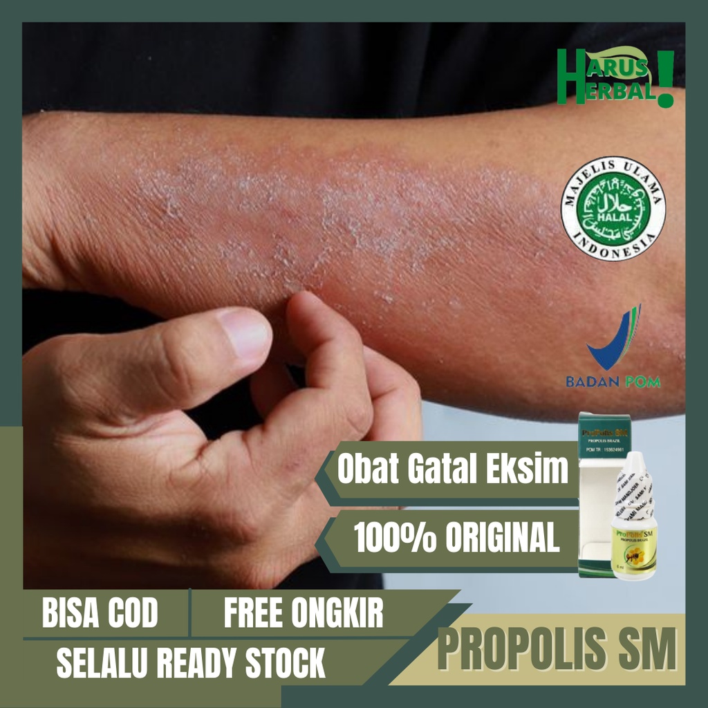 Obat Gatal Kulit Eksim Jamur, Obat Eksim Kering Menahun, Obat Masalah Kulit Gatal, Obat Jamur Kulit 