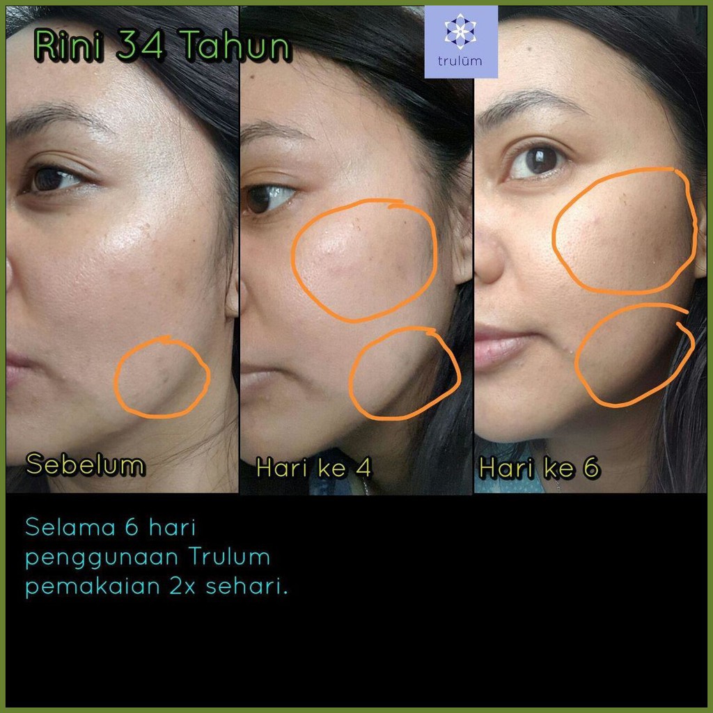 °425« Serum Untuk Menghilangkan Flek Hitam Cepat | Krim Pemutih Wajah Aman BPOM Trulum
