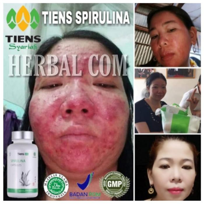 MASKER SPIRULINA TIENS 30 KAPSUL ORIGINAL/HILANGKAN JERAWAT&FLEK HITAM 