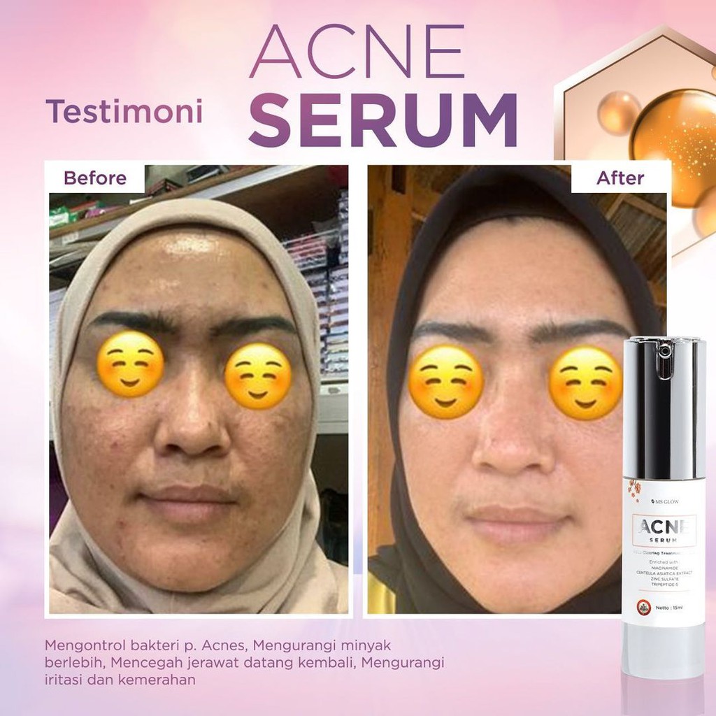 MS GLOW ACNE SERUM