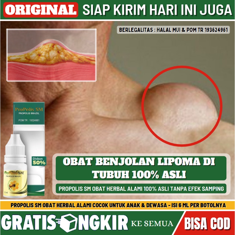 Jual Obat Lipoma Herbal, Obat Penghancur Benjolan Lipoma Di Tubuh 100% ...