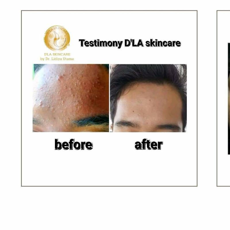 Paket Acne Whitening D'LA Skincare