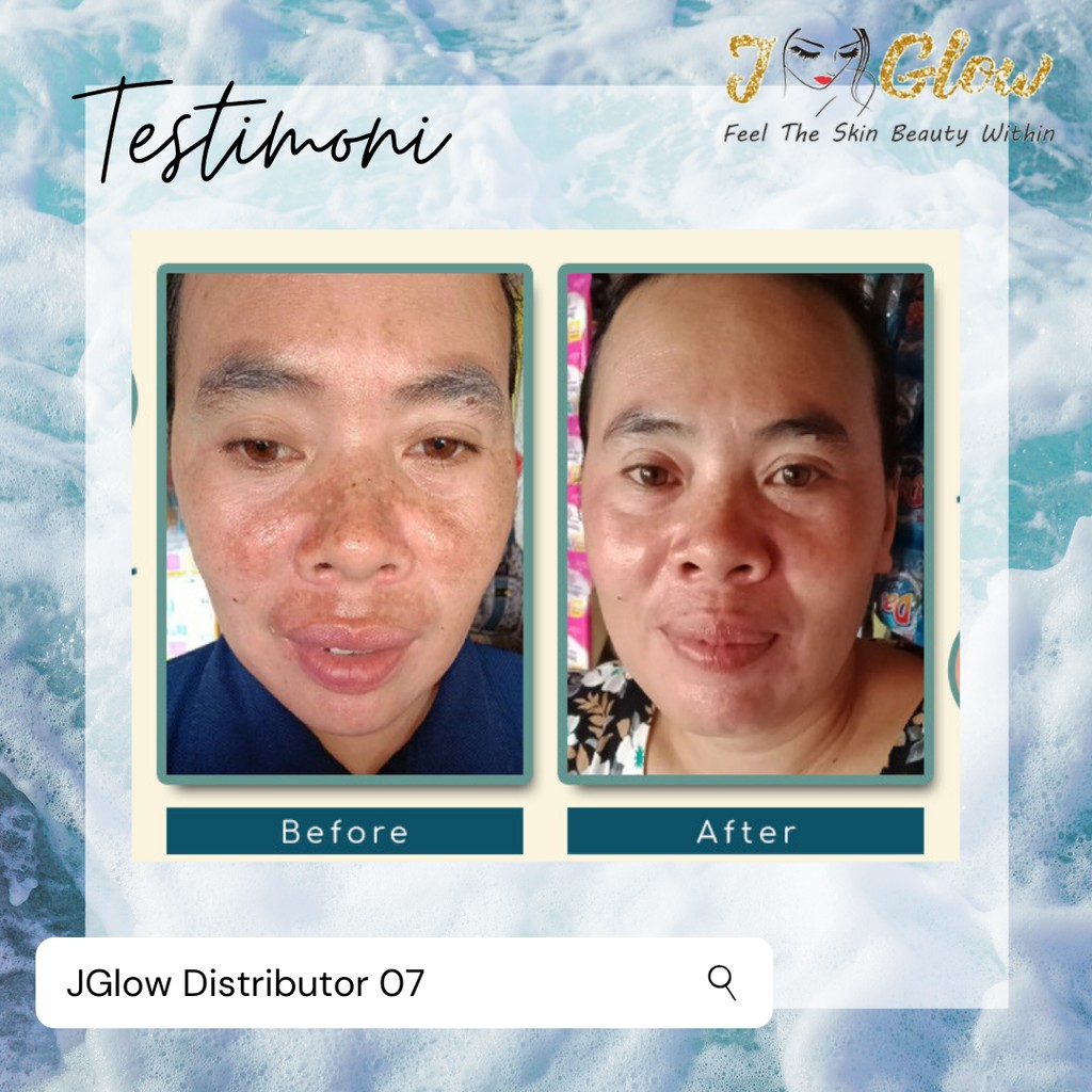 JGLOW Flek Melasma Hyperpigmentasi | Paket Perawatan Wajah Skincare BPOM-8