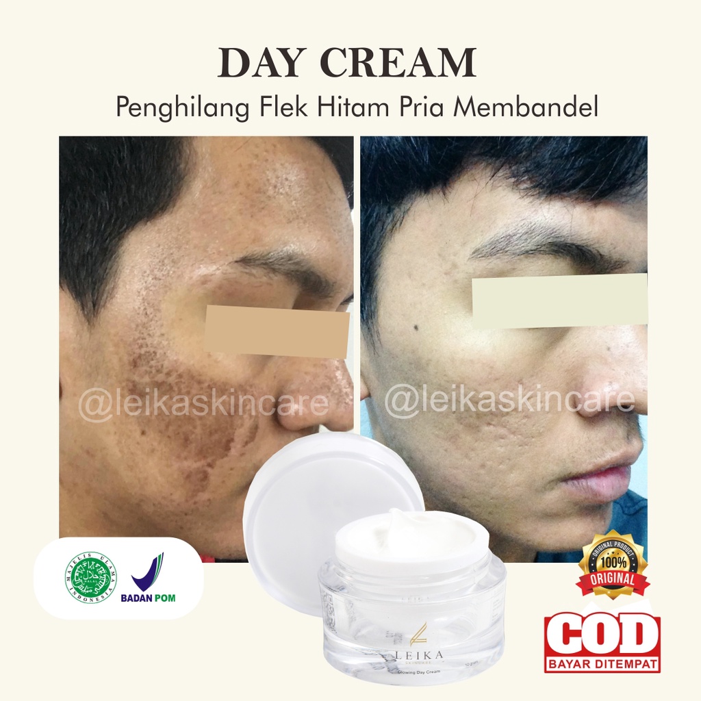 Cream Penghilang Flek Hitam Membandel Menahun Day Cream Penghilang Flek Hitam Di Wajah Pria Paling A