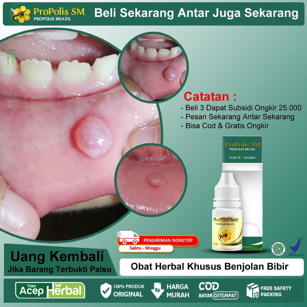 Obat Benjolan Di Bibir Mulut, Sakit dan Nyeri, Gusi Bengkak/Berdarah, Bau Mulut, Abses, Sariawan, Mulut Kering, Bibir Pecah Pecah, Kanker Lidah, Infeksi Jamur, Sakit Saat Menelan, Amandel, Kista, Herpes Oral - PROPOLIS SM BRAZILIAN 100% ORIGINAL BPOM