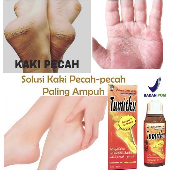 Tumitku Obat Kaki Pecah Kapalan Penghalus Tumit Kaki Obat Kapalan