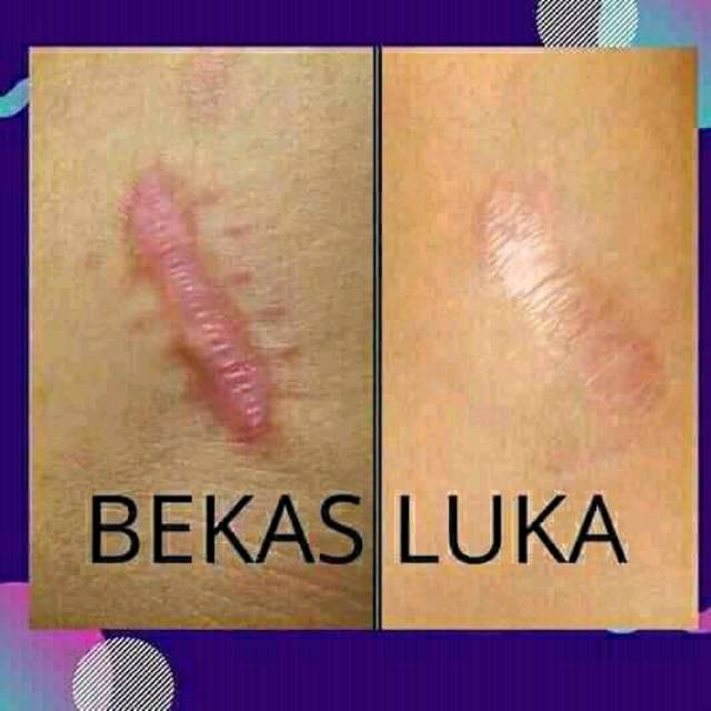 terlaris penghilang bekas luka jahitan / luka bakar