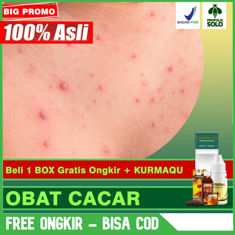 Obat Herbal Cacar, Cacar Air, Cacar Monyet, Cacar Ular Pada AnakPropolis SM Brazil Bisa COD di SOLO