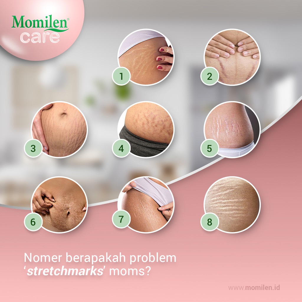 MOMILEN Stretch Mark Cream 30gr / Intensive Tummy / Penghilang Selulit / Garis Perut / Luka Perut