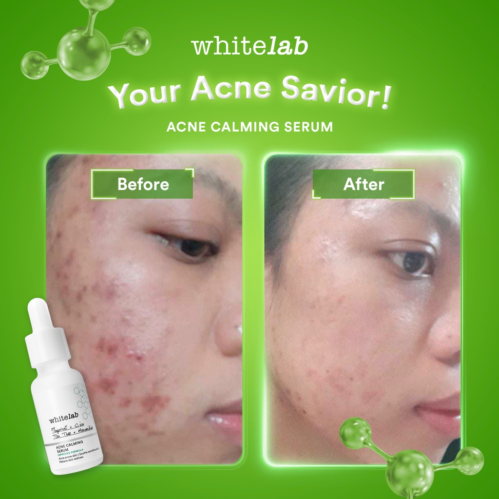 Whitelab Acne Care Facial Wash | Calming Serum | Toner | Cream | Soap Untuk Kulit Berjerawat White Lab