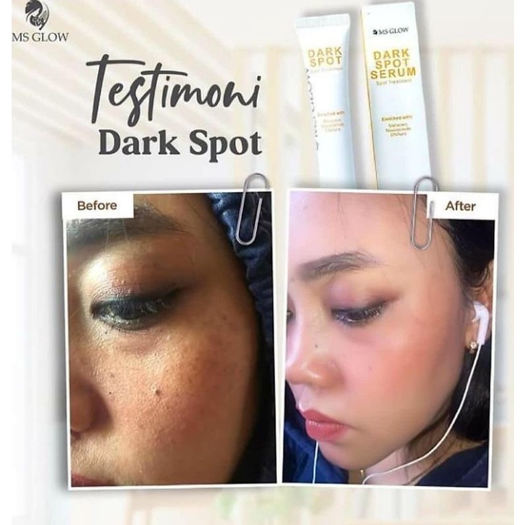 Dark Spot Treatment Serum II Khusus Flek MS GLOW