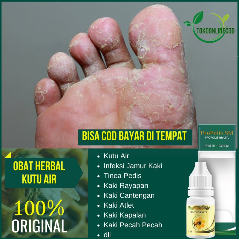 Obat Kutu Air - Kutu Air Kaki - Kutu Air Tangan - Tinea Pedis - Penyakit Kulit - Infeksi Jamur Kaki