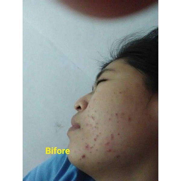 shineskin skincare acne