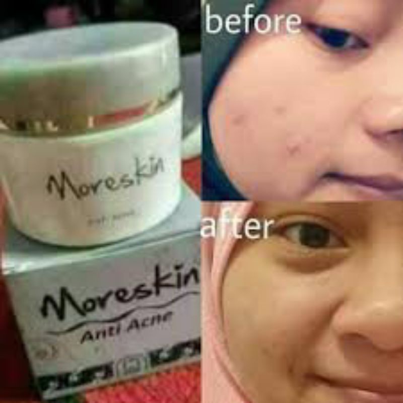 Paket jerawat moreskin acne + sabun acne