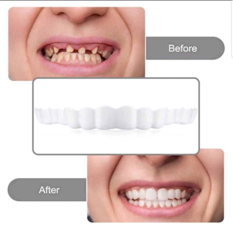 Snap On Smile Authentic 100% Original/ Gigi Palsu 1 Set Sepasang Atas Bawah