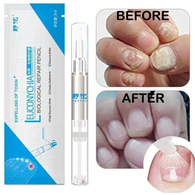 Obat kuku jamur dan rusak busuk berjamur jamuran paling ampuh, serum kamur kuku obat kuku jamuran