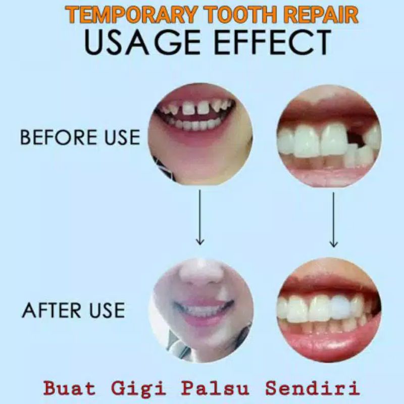 TEMPTOOTH Polymorph Gel Padat untuk buat Gigi Palsu sendiri