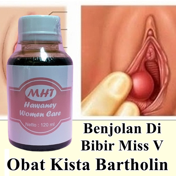 Obat Antibiotik Untuk Kista Bartholin Di Apotik | Daun Sirih Untuk Kista Bartholin | Pantangan Benjo