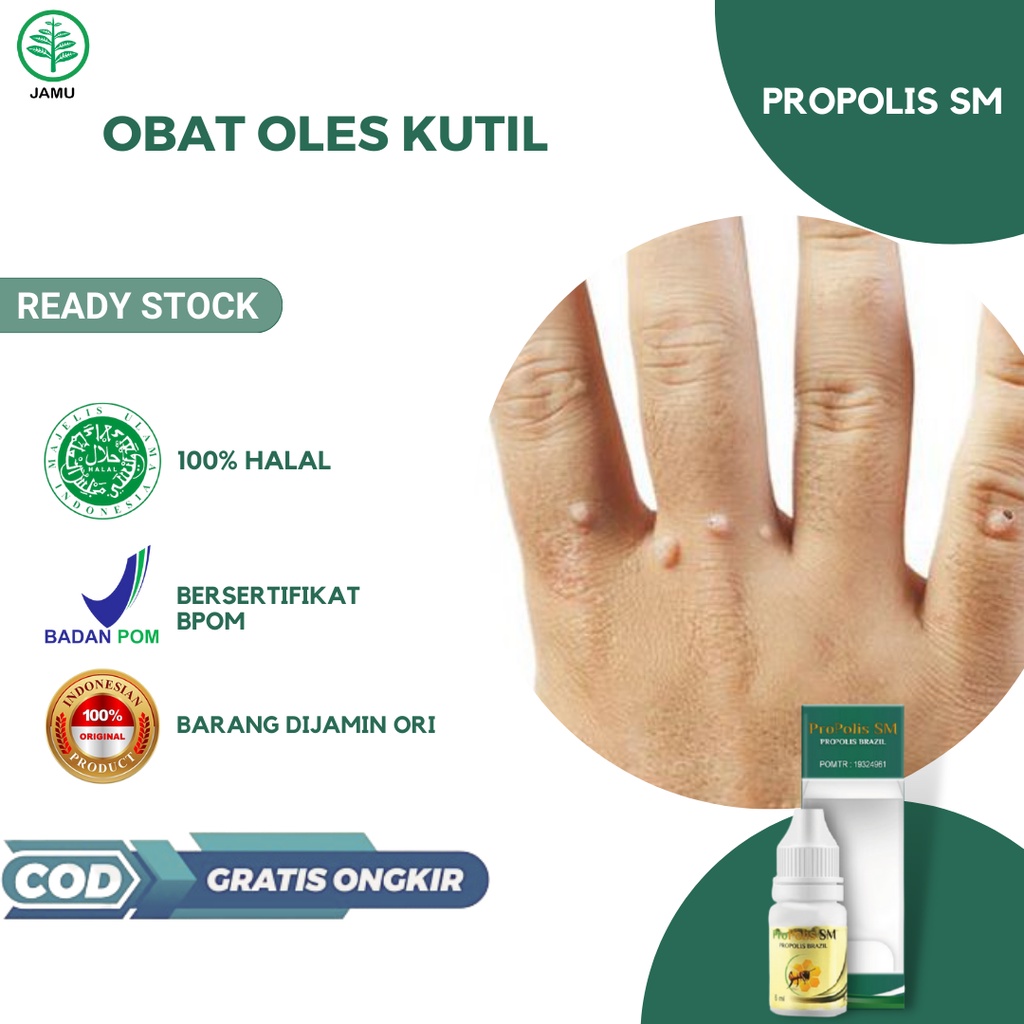 Obat Caplak Kutil, Obat Penghilang Kutil, Obat Bintik Bintik di Jari, Obat Kutil di Jari Tangan, Oba