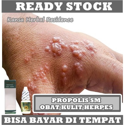 Obat Herpes Bercak Berair Panas Mengobati Herpes Secara Alami - Mengurangi Rasa Gatal - Membantu Menetralisir Virus Herpes - 100% Terbuat dari Bahan Herbal Alami - Mampu Mengobati Berbagai Macam Jenis Penyakit Herpes Asli ProPolis SM Brazil