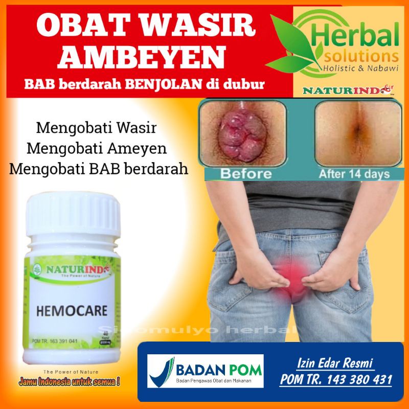 obat wasir ambeyen bengkak pada anus bab darah sakit saat bab stadium 1 sampai 4