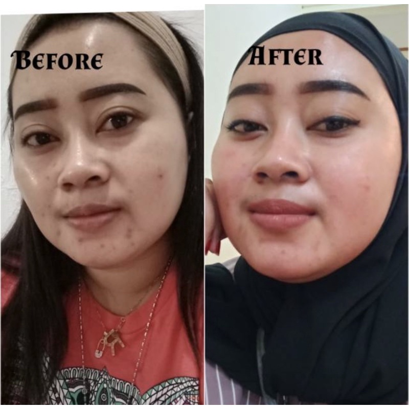 Totol Acne Jerawat Bbc Bebwhite c