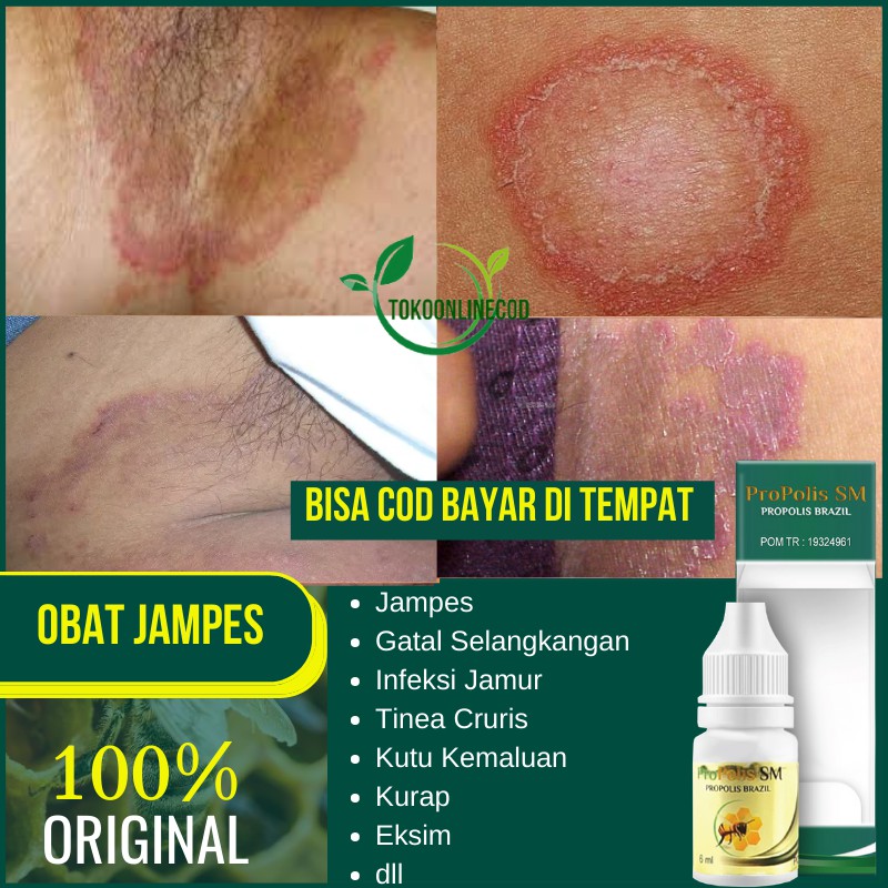 Jual Obat Jampes, Penghilang Jampes, Jamur Kulit, Tinea Cruris, Kurap