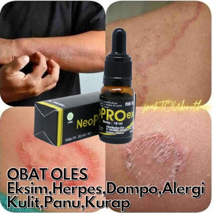 Jual Jual Obat Herpes, Obat Herpes Bibir, Obat Herpes, Obat Herbal