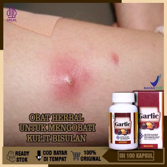 Obat Untuk Kulit Bisul, Obat Herbal Bisul Alami,  Obat Alami untuk Mengobati Bisul, Obat Bisul Berna