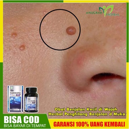 Jual Obat Benjolan Kecil Di Wajah | Herbal Penghilang Benjolan D Muka ...