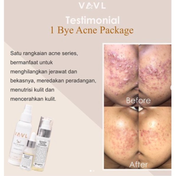 Skinhouseid Vightne Sunscreen Blemish Serum Vavl Beauty Water Original Perawatan Kulit Wajah Berjerawat BPOM