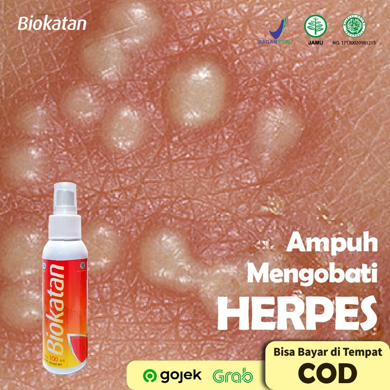 BIOKATAN SPRAY Ampuh Memulihkan Sakit dan Gatal Herpes Pada Kulit Anda
